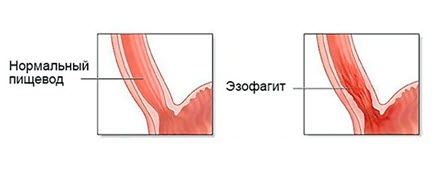 симптоматика эзофагита